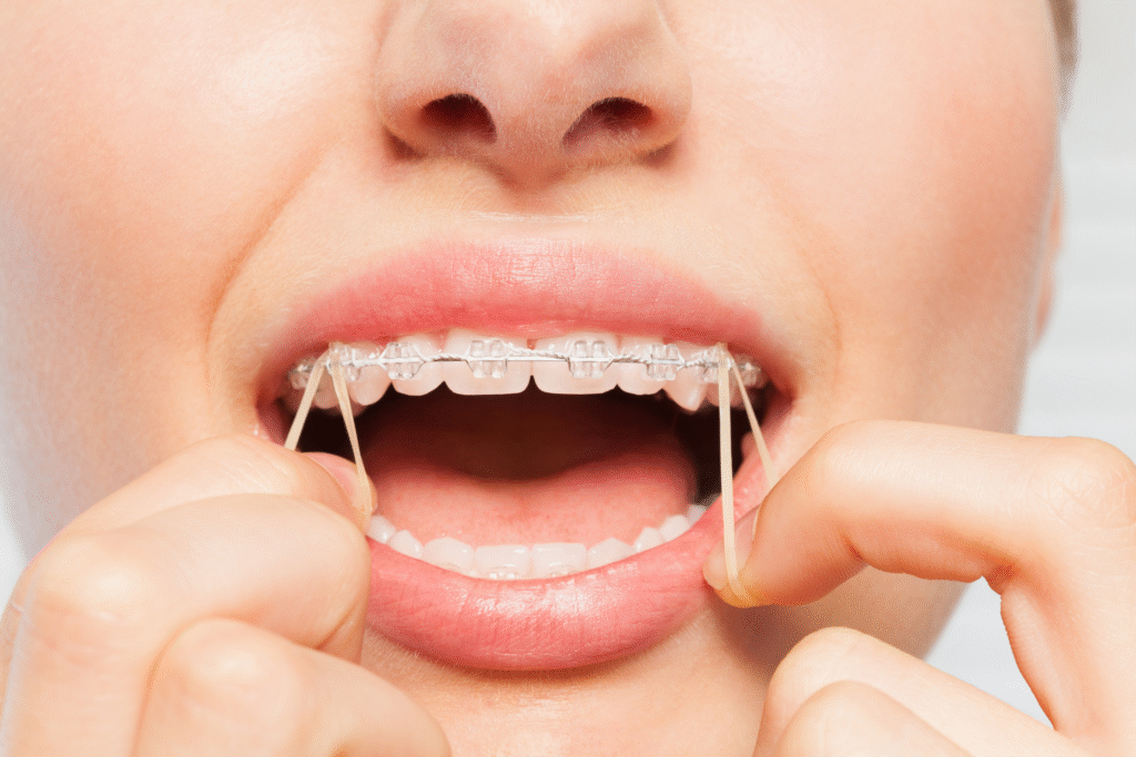 Early Orthodontics
