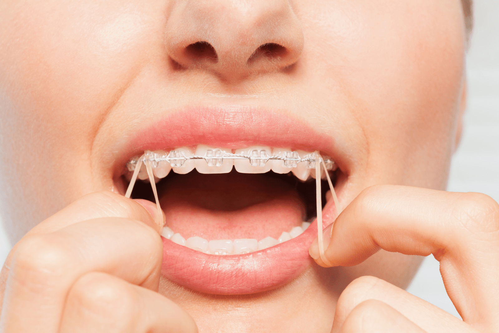 Early Orthodontics